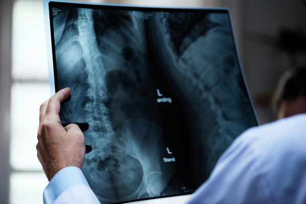 Who is at Risk for a Spinal Fracture? – A Comparative Study of National Health and Nutrition Examination Survey Data