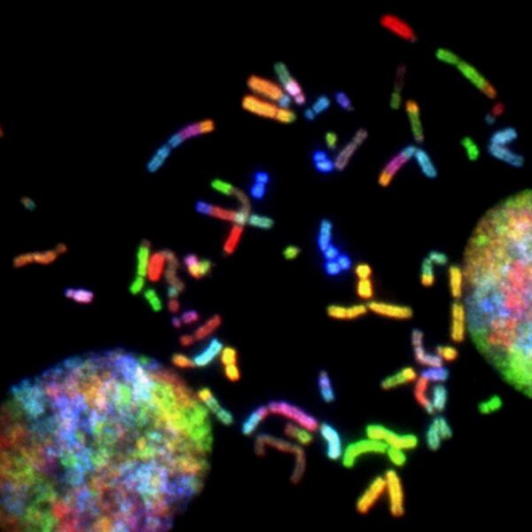 Analysis of complement system gene expression and outcome across the subtypes of glioma